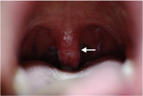Emmett et al suggested that men are at a higher risk of developing <b>uvular</b> oedema or <b>necrosis</b> owing to the bulkier tongue and palate with significantly more non-fat tissue in the neck. . Uvular necrosis healing time